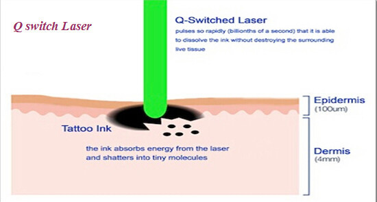 máquina rápida del retiro del pelo del laser de la venta 2014 calientes del xglaser